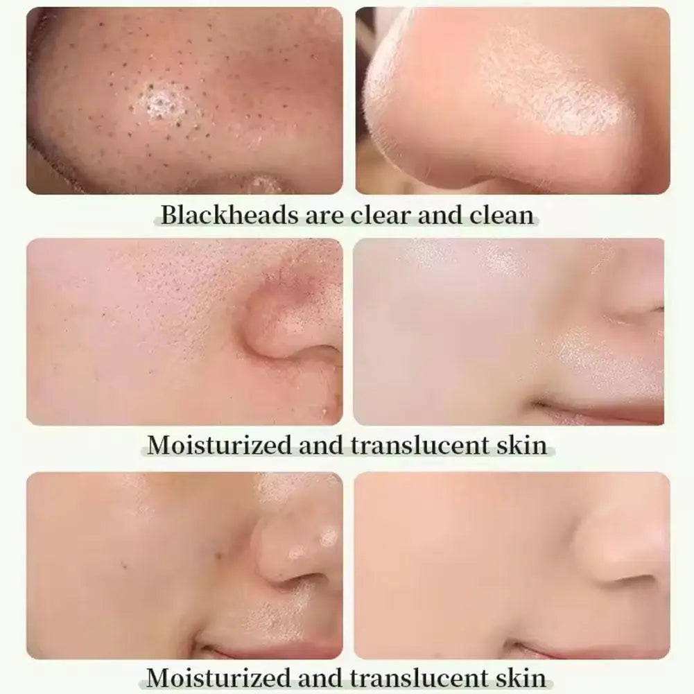 Máscara Removedor de Cravos e Limpeza Facial Green Mask™