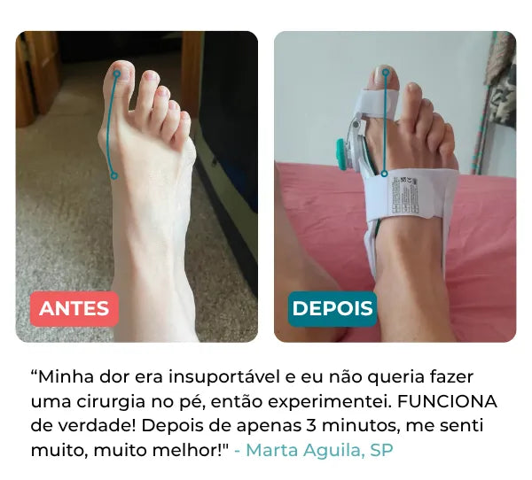 Corretor Ortopédico para Joanetes Confort™