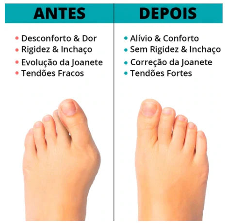 Corretor Ortopédico para Joanetes Confort™